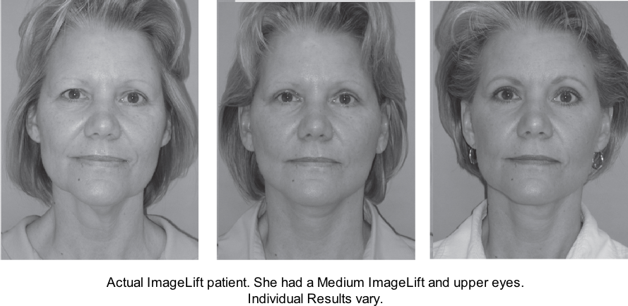 ImageLift Patient