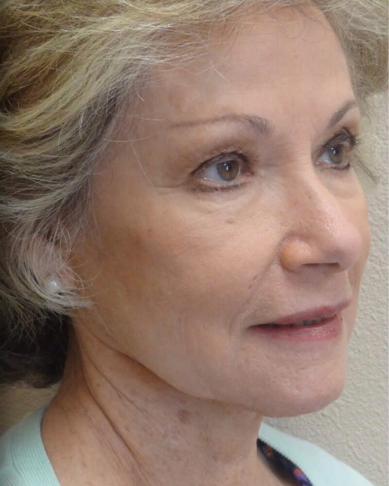 upper blepharoplasty female patient 1 after treatment