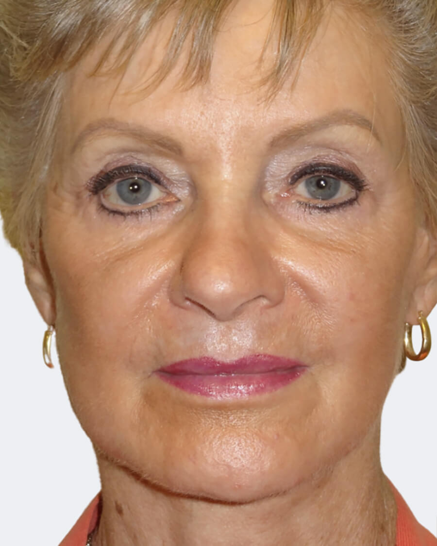 Face Filler Before and After Pictures Tampa and The Villages, FL