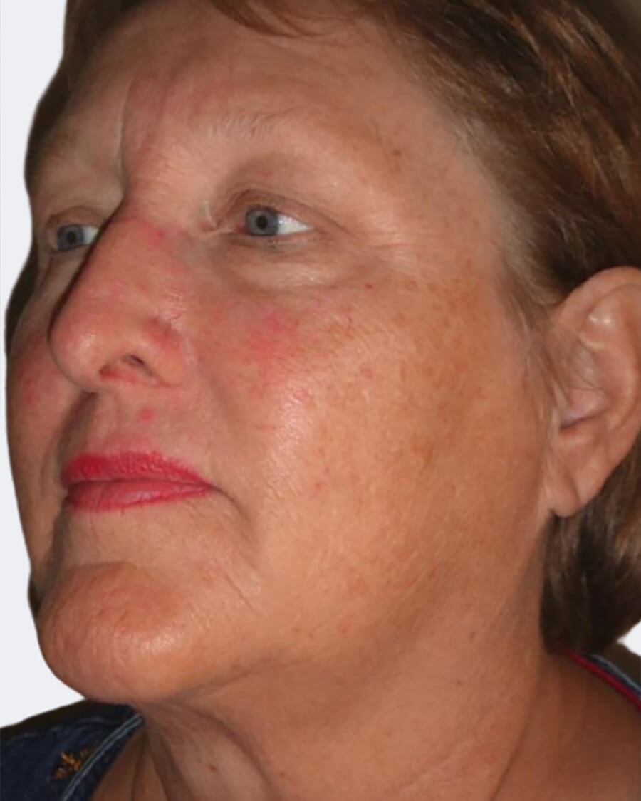 Face Filler Before and After Pictures Tampa and The Villages, FL