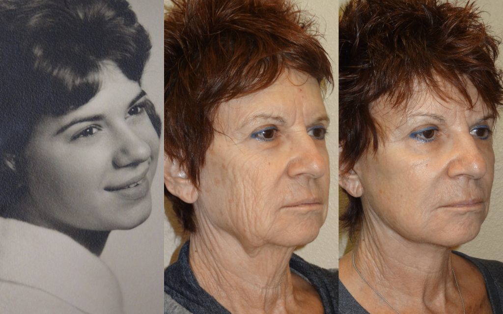 Facelift Patient 01