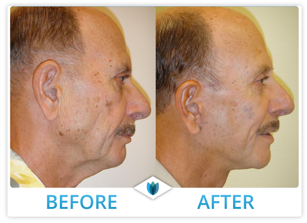 Facelift Patient 07
