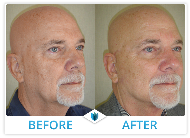 Facelift Patient 08