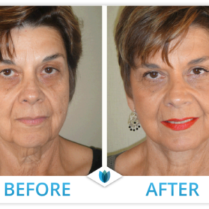 Patient 2. forward facing