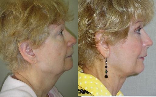 Facelift Patient 05