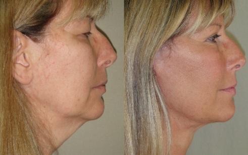 Facelift Patient 03