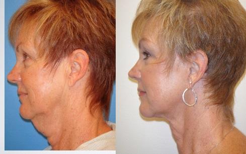 Facelift Patient 04