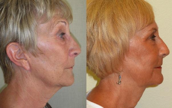 Facelift Patient 06