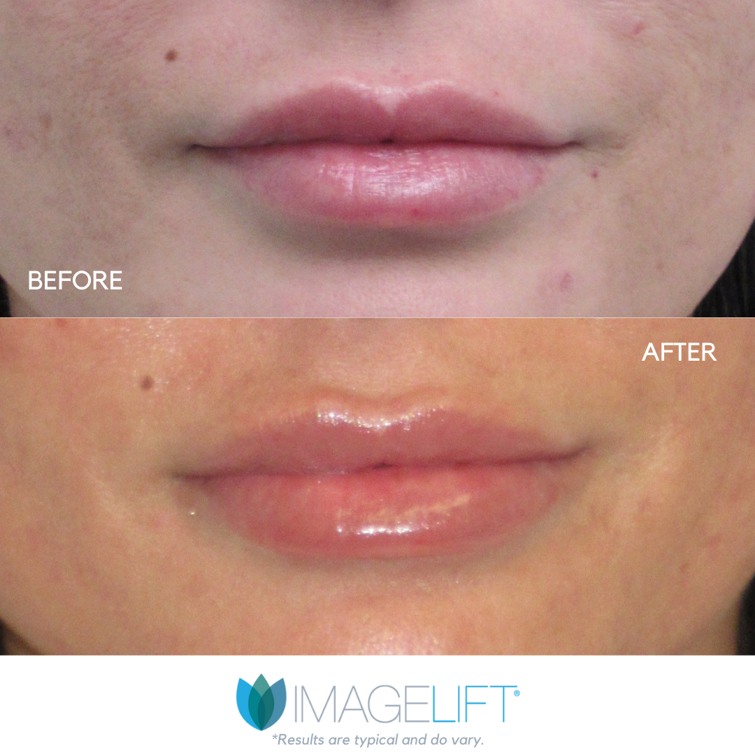 Facial Filler Before and After Pictures Tampa and The Villages, FL