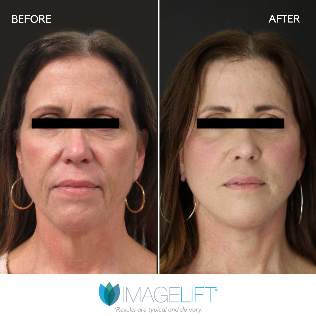 Facial Filler Before and After Pictures Tampa and The Villages, FL