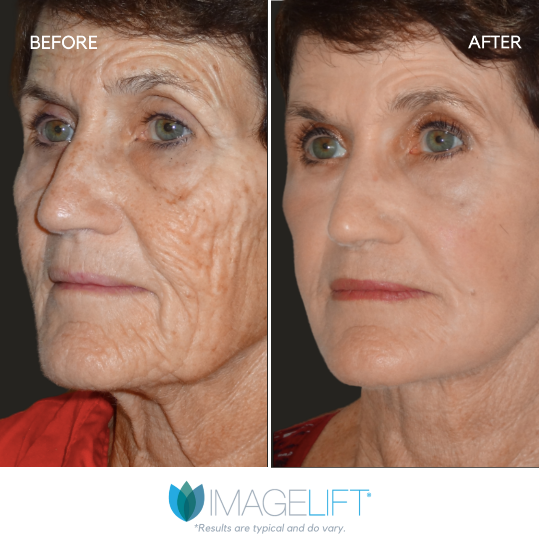 Facial Filler Before and After Pictures Tampa and The Villages, FL