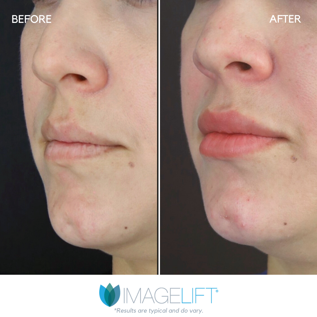 Facial Filler Before and After Pictures Tampa and The Villages, FL