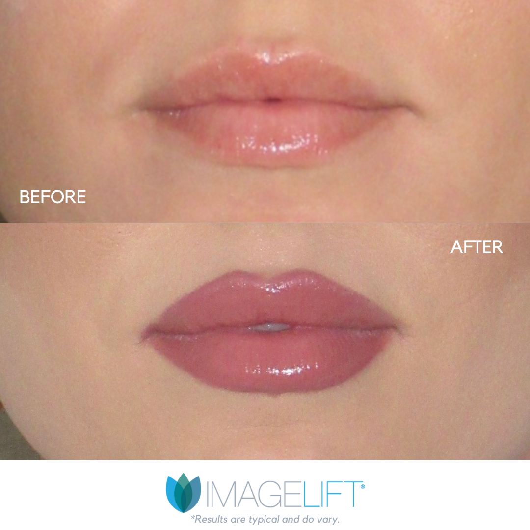 Facial Filler Before and After Pictures Tampa and The Villages, FL