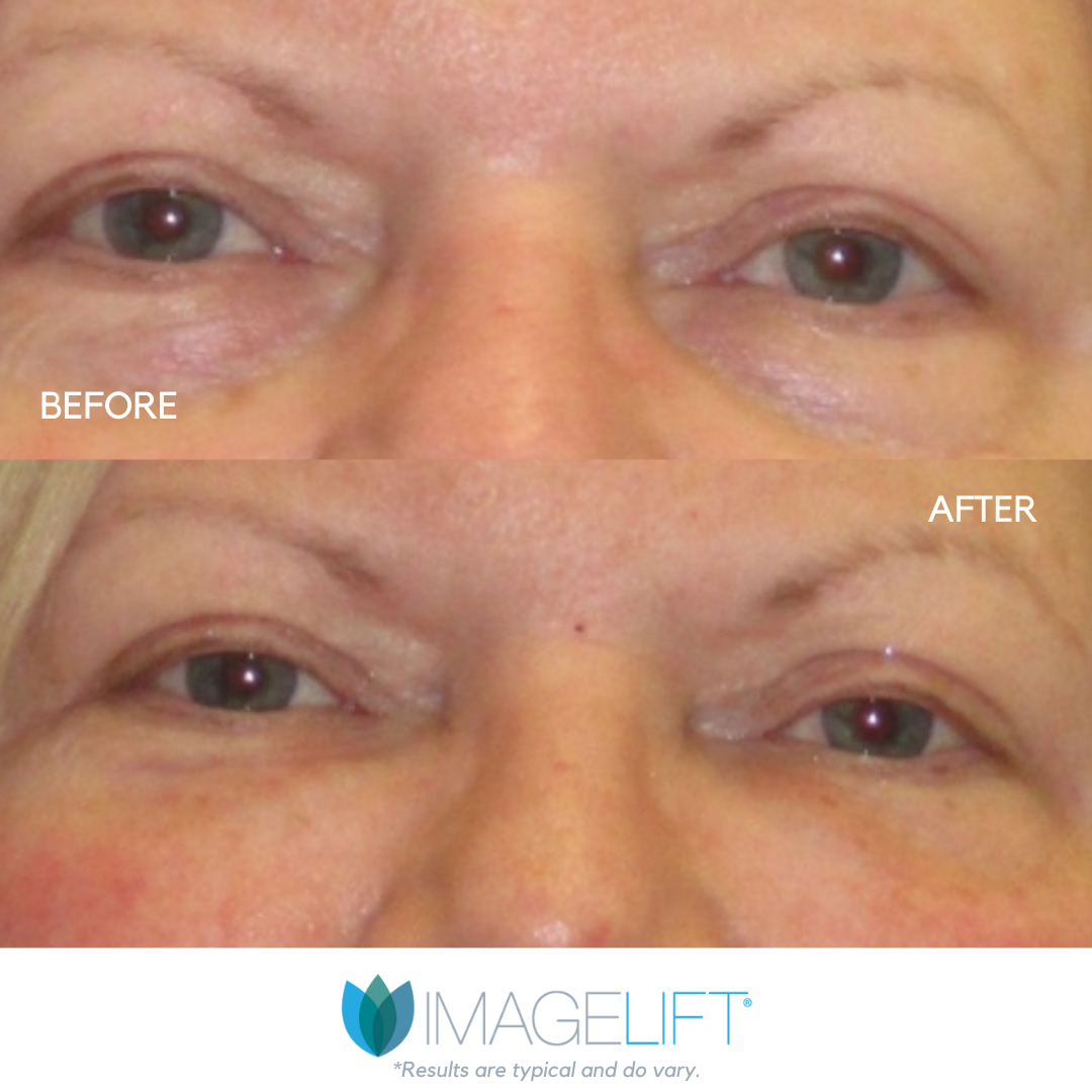 Facial Filler Before and After Pictures Tampa and The Villages, FL