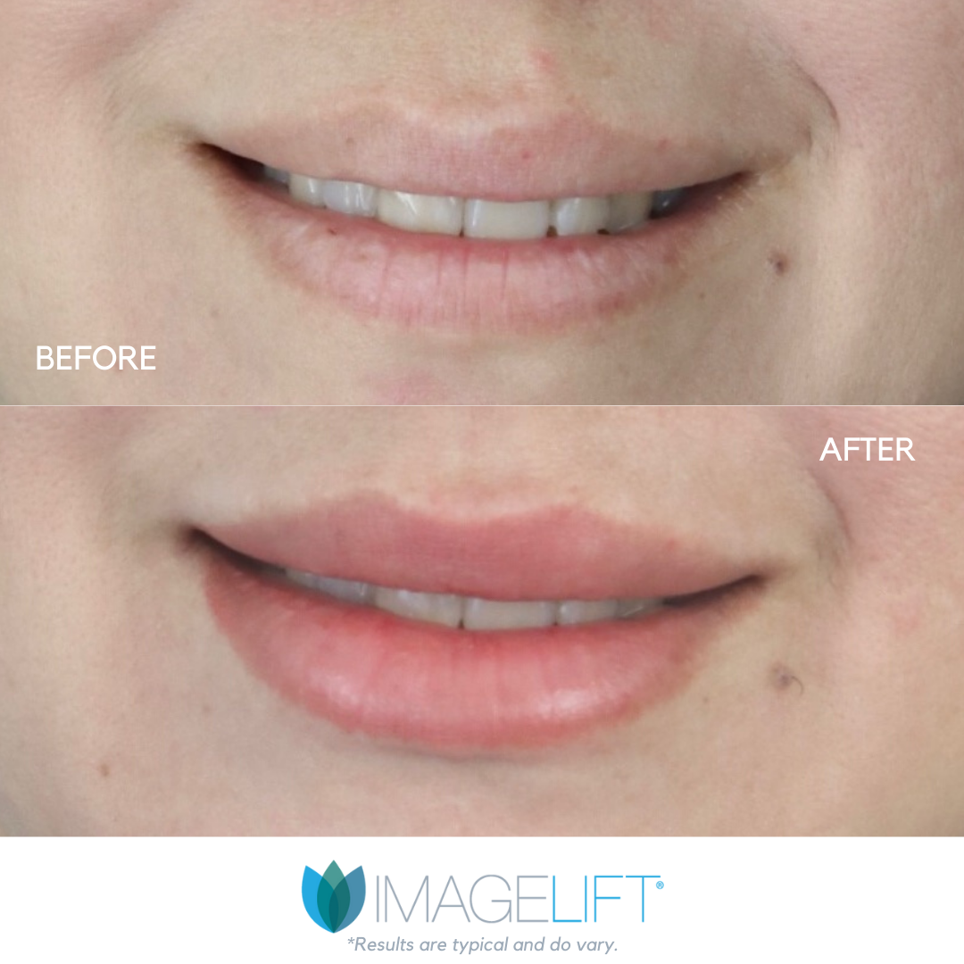 Facial Filler Before and After Pictures Tampa and The Villages, FL