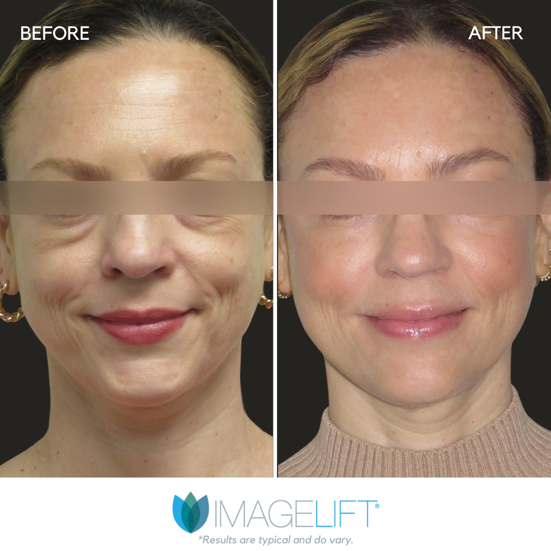 Facial Filler Before and After Pictures Tampa and The Villages, FL