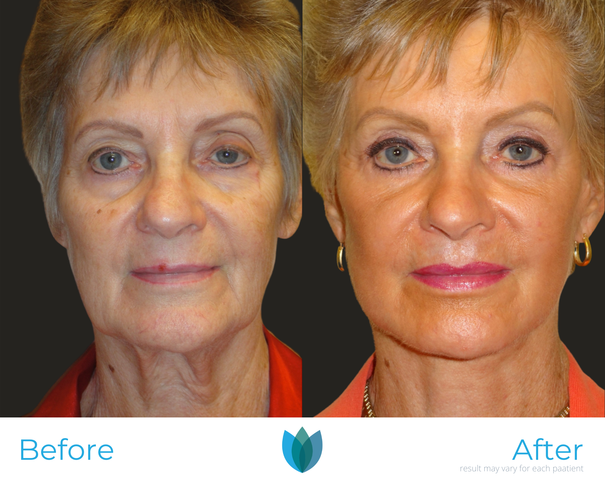 Laser Treatments Before and After Pictures Tampa and The Villages, FL