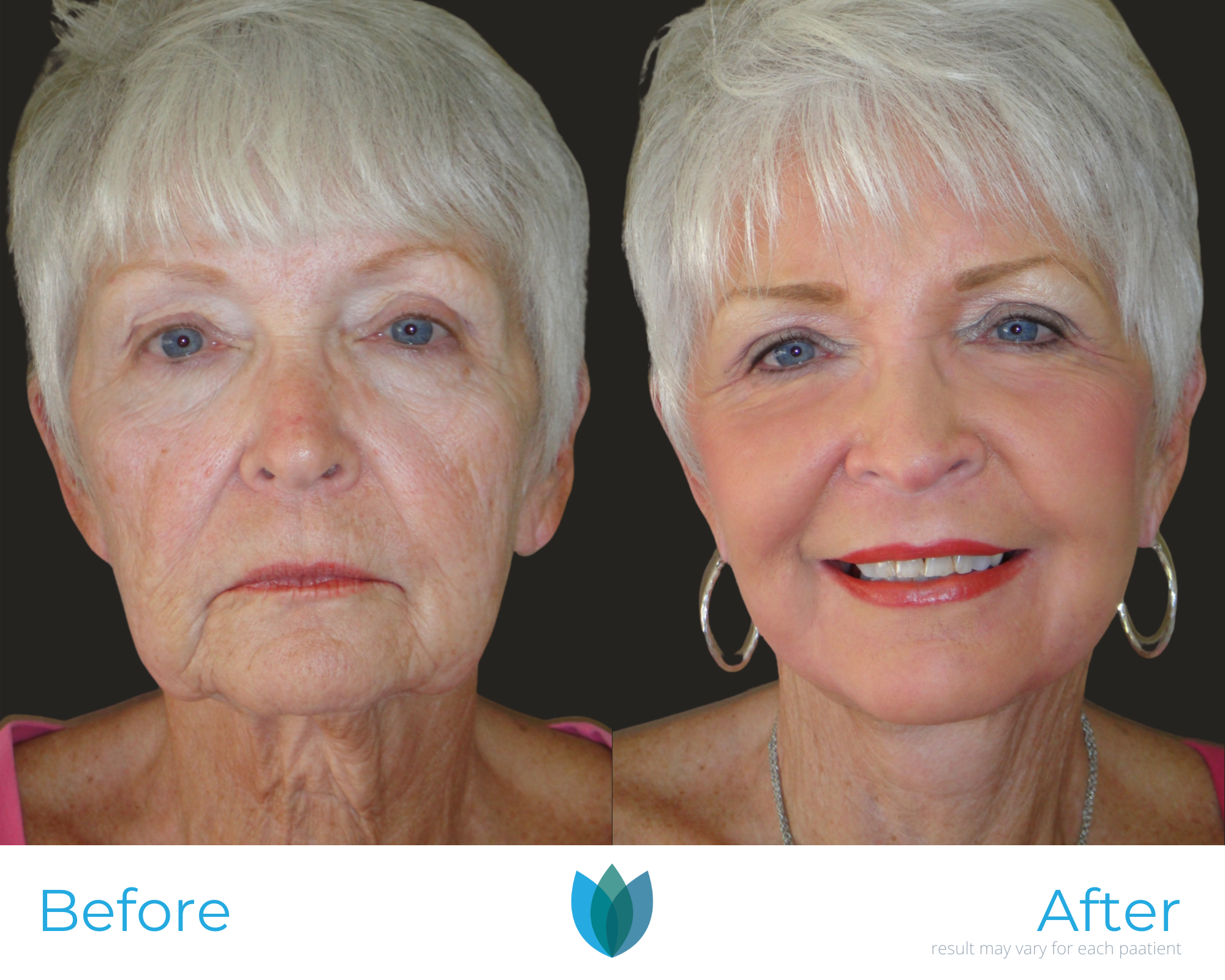 Laser Treatments Before and After Pictures Tampa and The Villages, FL