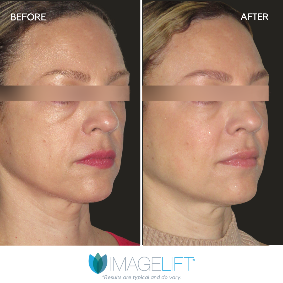 Facial Filler Before and After Pictures Tampa and The Villages, FL