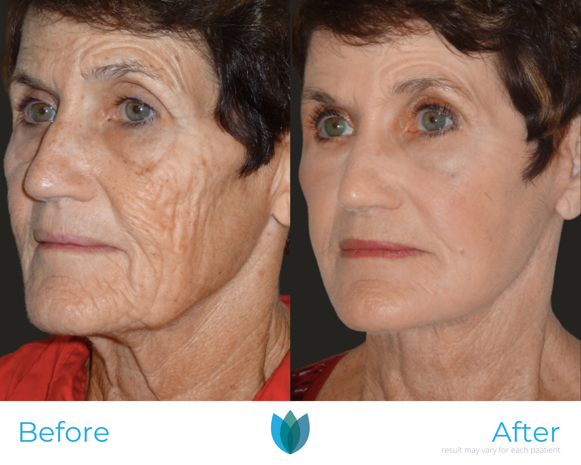 Laser Treatments Before and After Pictures Tampa and The Villages, FL