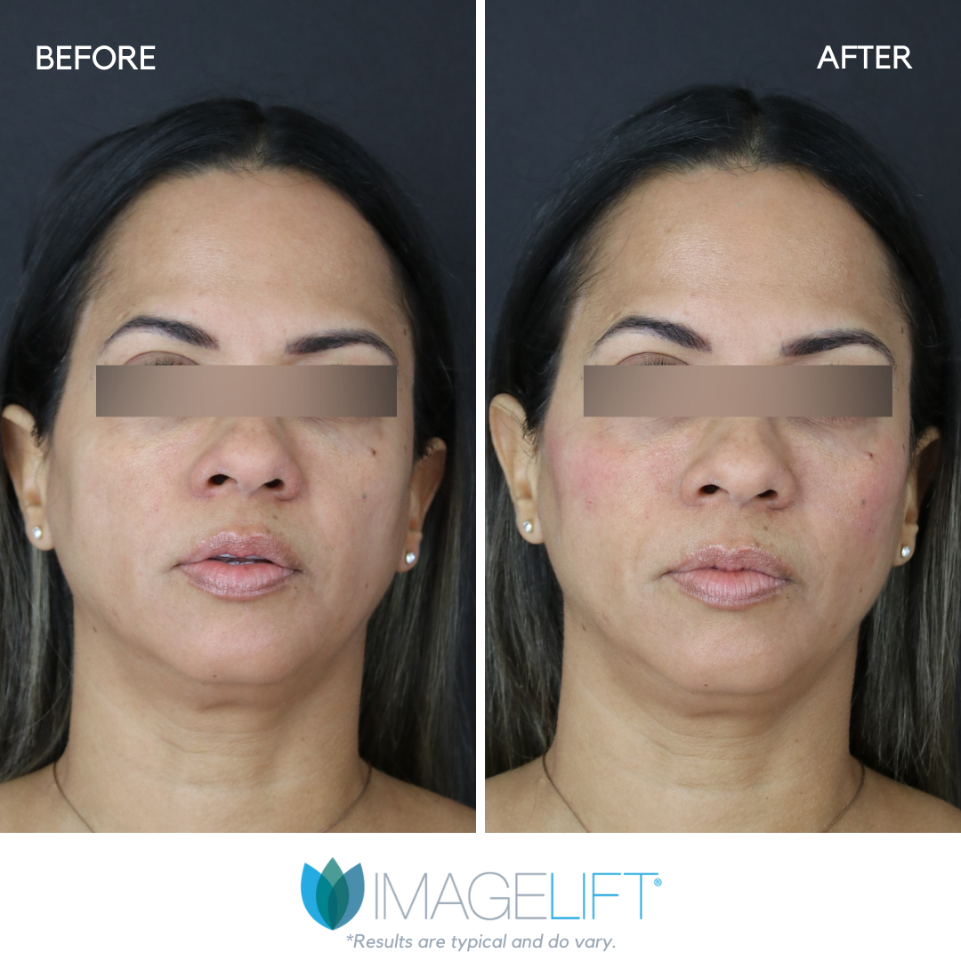 Facial Filler Before and After Pictures Tampa and The Villages, FL