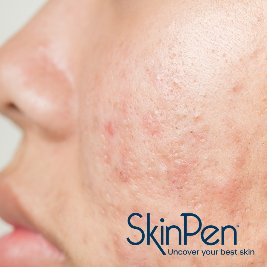 Close up of blemishes on a cheek