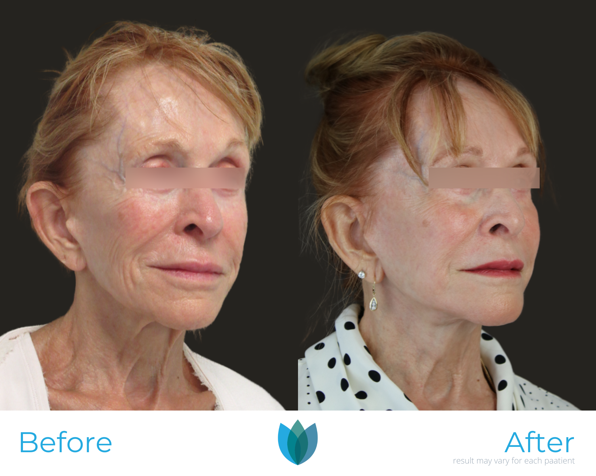 Facelift Before and After Pictures Tampa and The Villages, FL