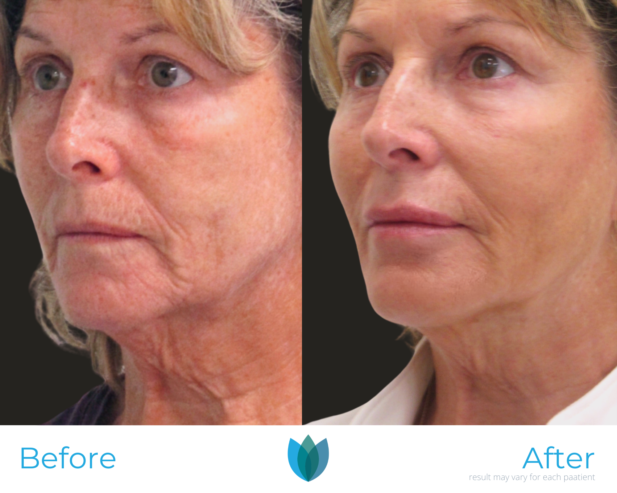 Facelift Before and After Pictures Tampa and The Villages, FL