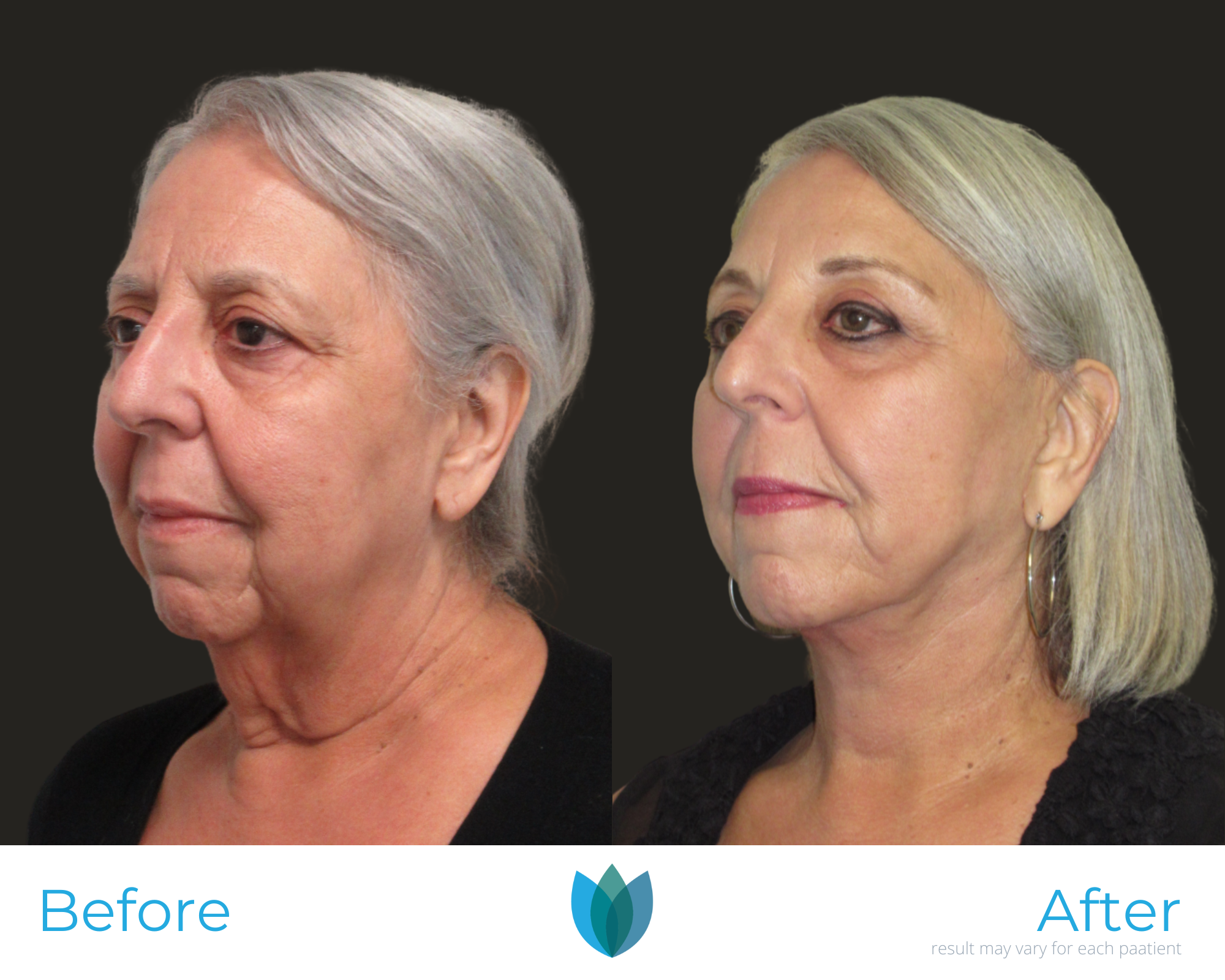 Facelift Before and After Pictures Tampa and The Villages, FL