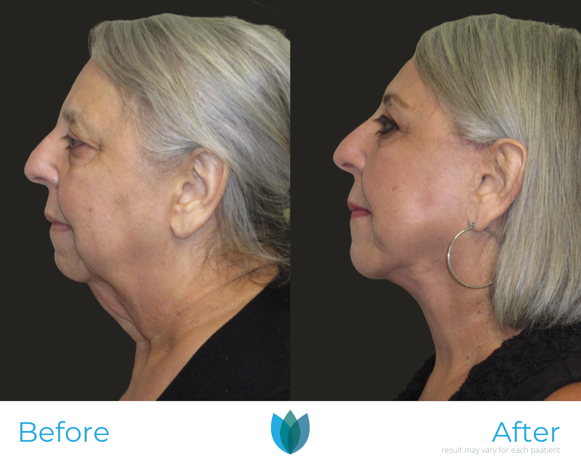 Facelift Before and After Pictures Tampa and The Villages, FL