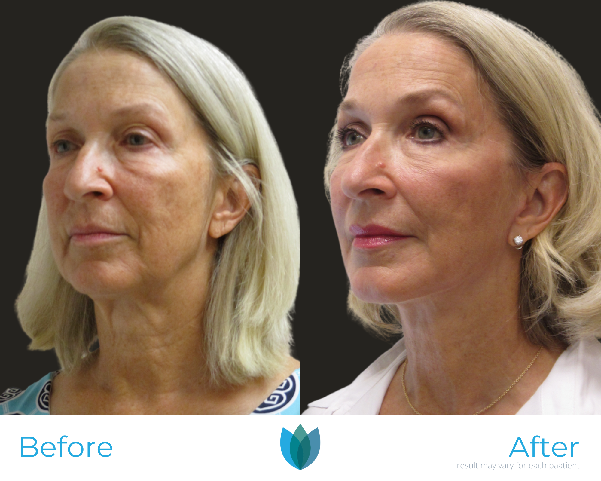 Facelift Before and After Pictures Tampa and The Villages, FL