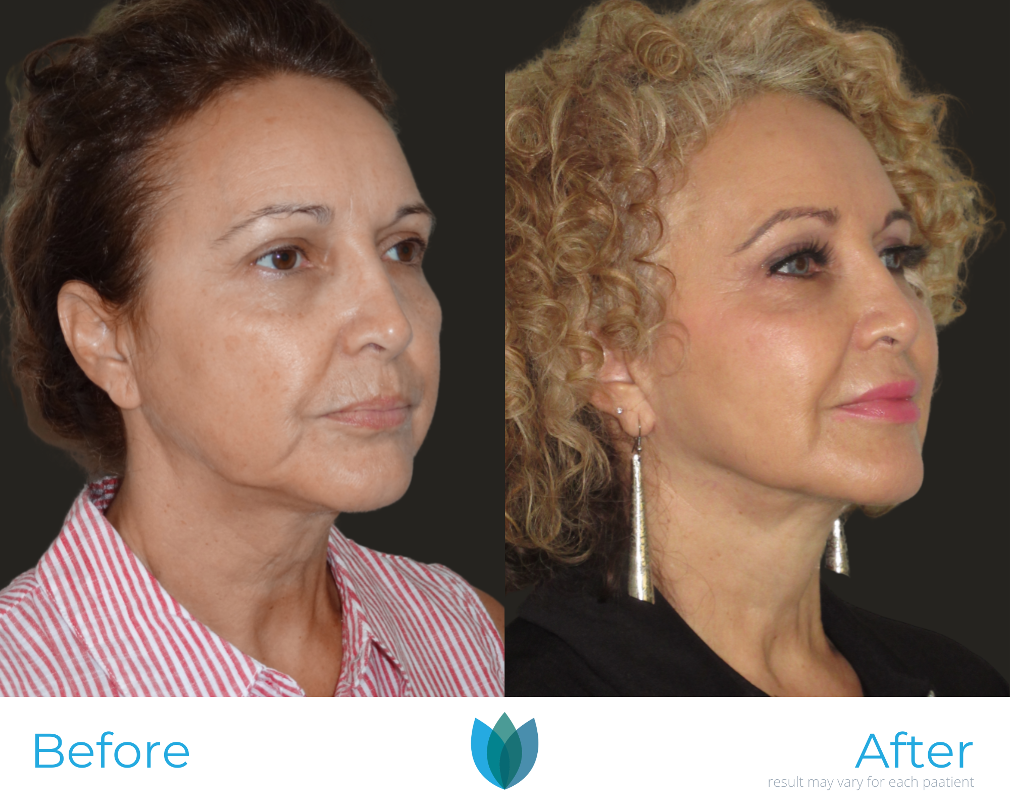 Facelift Before and After Pictures Tampa and The Villages, FL