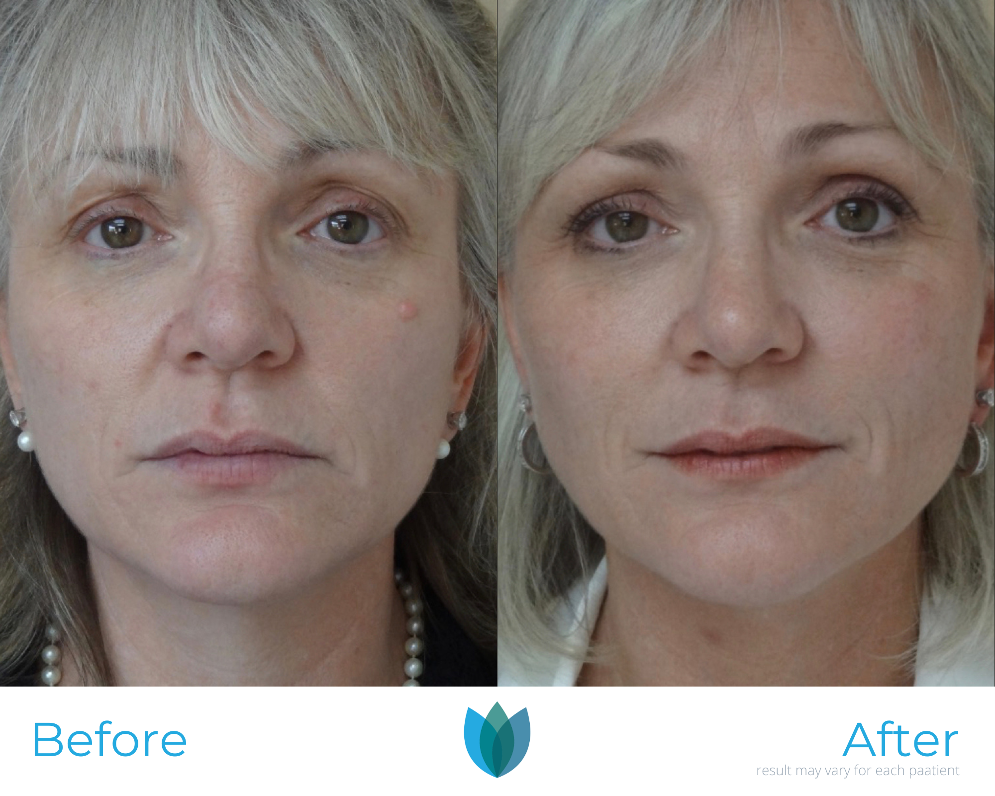 Facelift Before and After Pictures Tampa and The Villages, FL