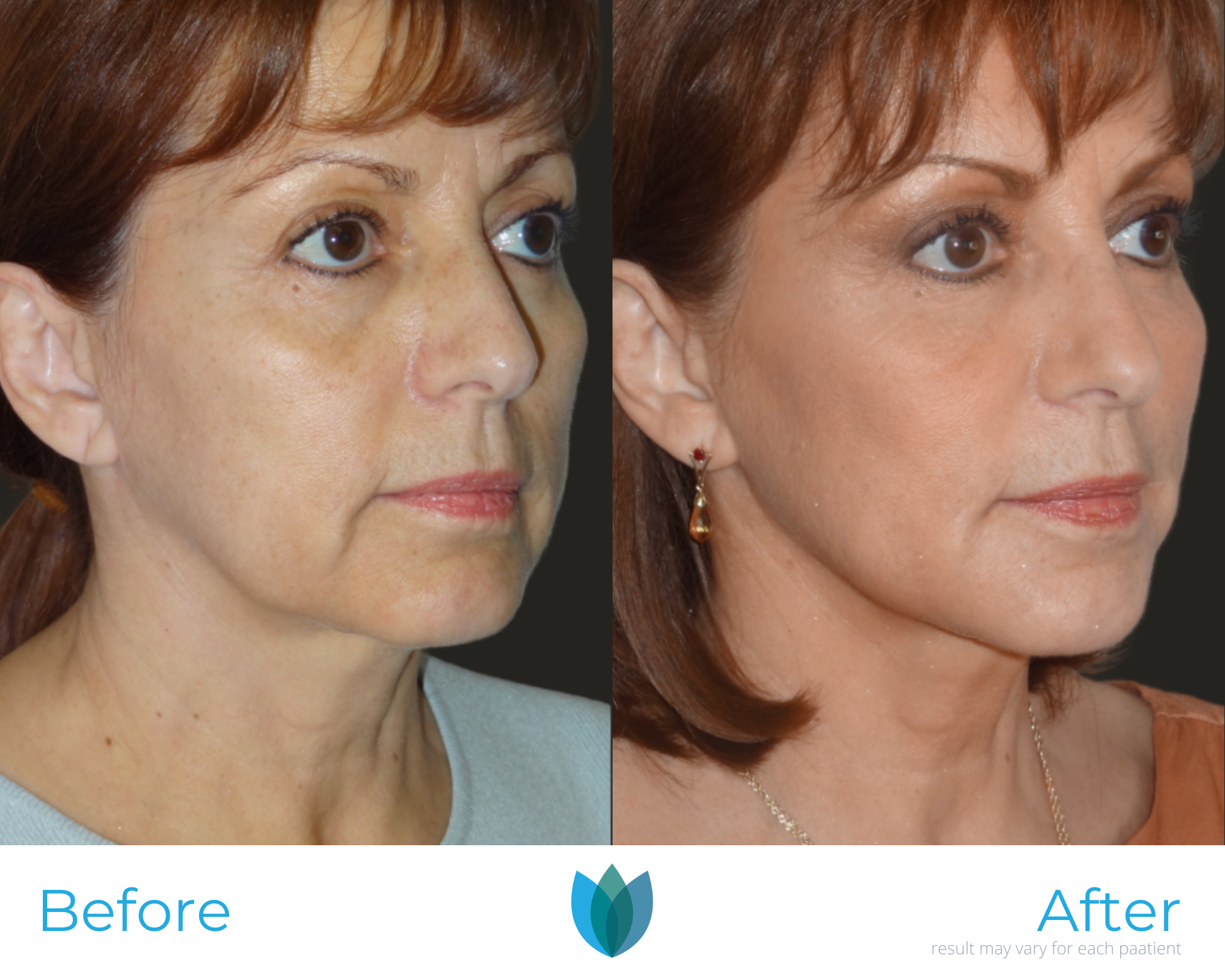 Facelift Before and After Pictures Tampa and The Villages, FL