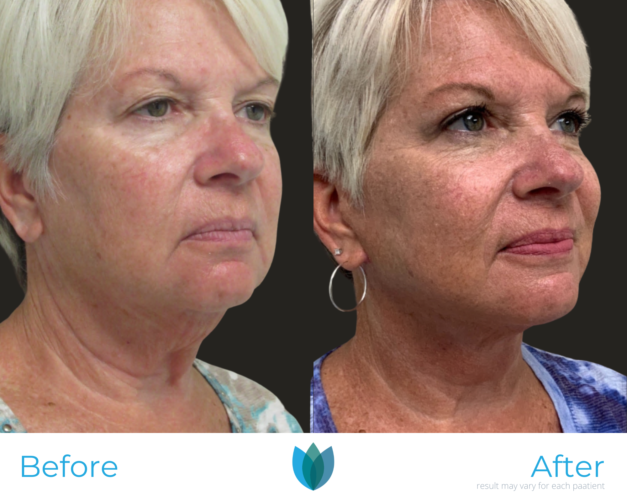 Facelift Before and After Pictures Tampa and The Villages, FL