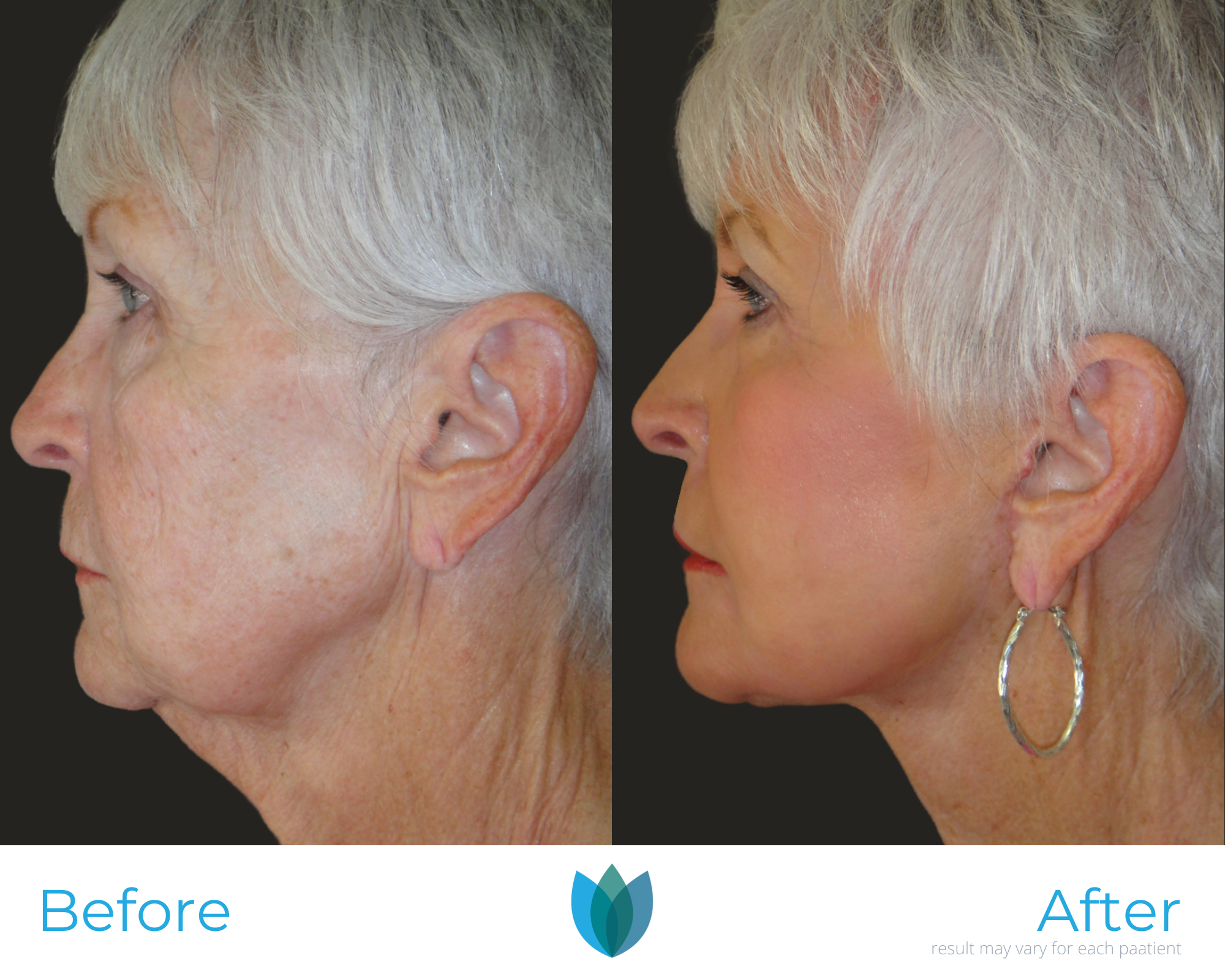 Facelift Before and After Pictures Tampa and The Villages, FL