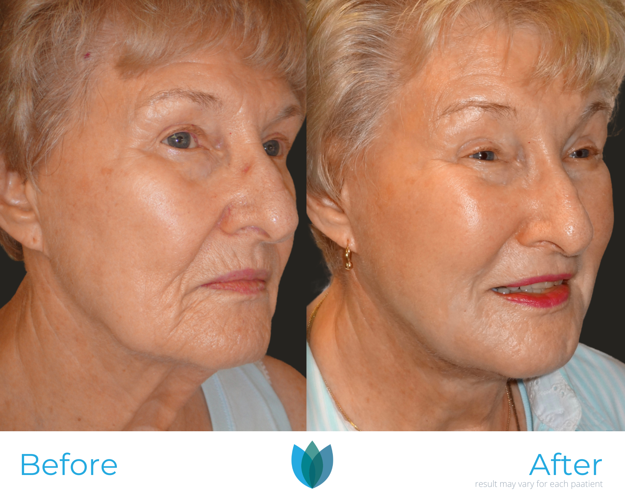 Facelift Before and After Pictures Tampa and The Villages, FL