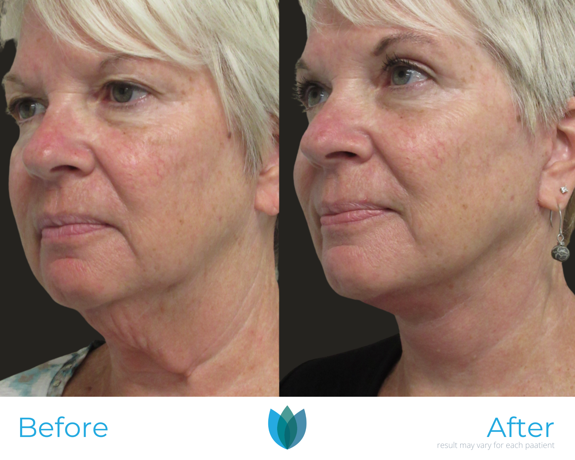 Facelift Before and After Pictures Tampa and The Villages, FL