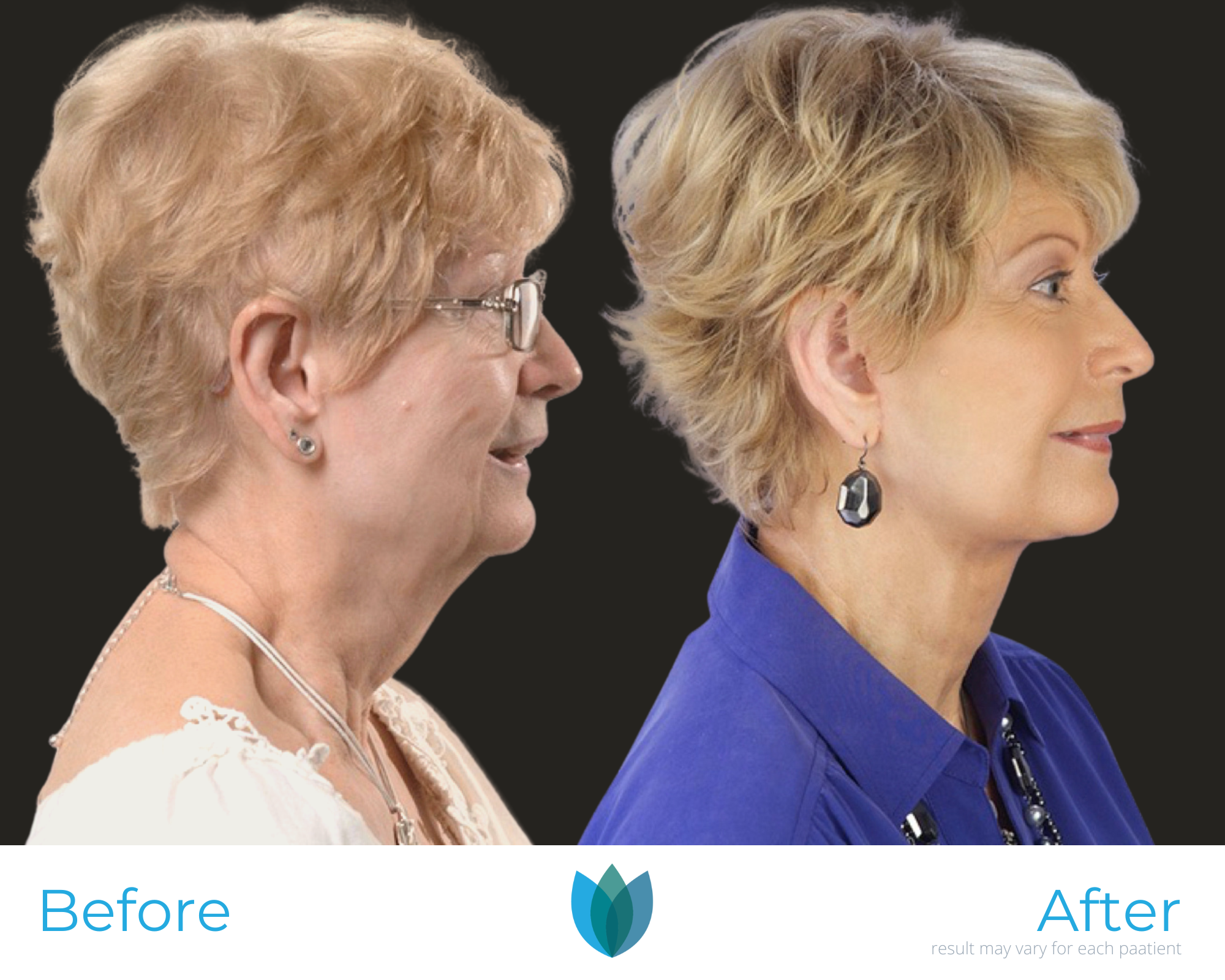 Facelift Before and After Pictures Tampa and The Villages, FL