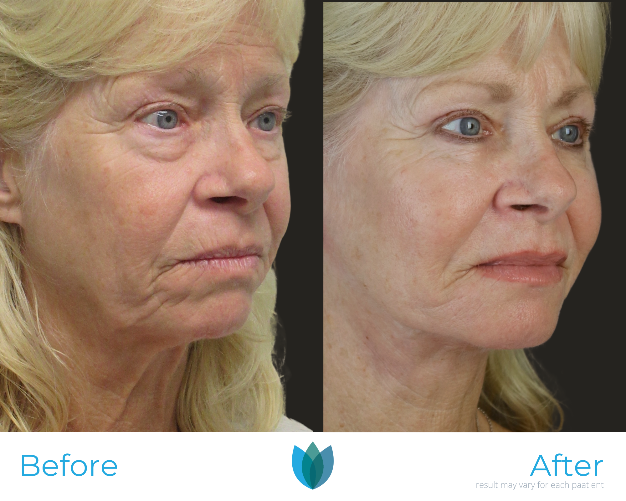 Facelift Before and After Pictures Tampa and The Villages, FL