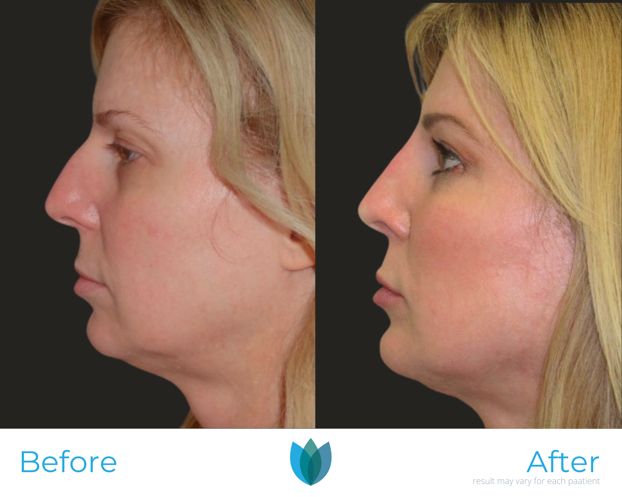 Facelift Before and After Pictures Tampa and The Villages, FL