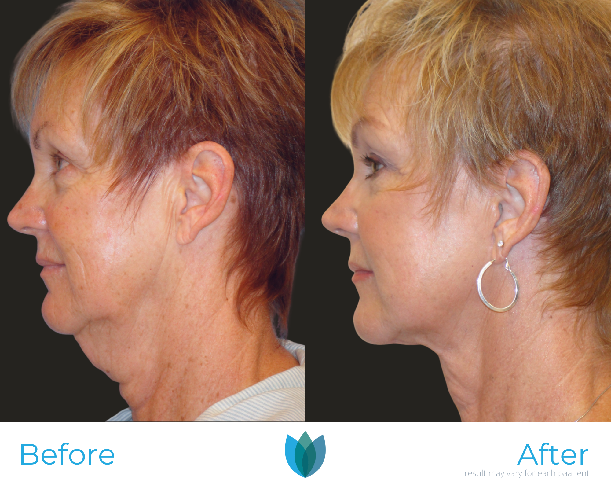 Facelift Before and After Pictures Tampa and The Villages, FL