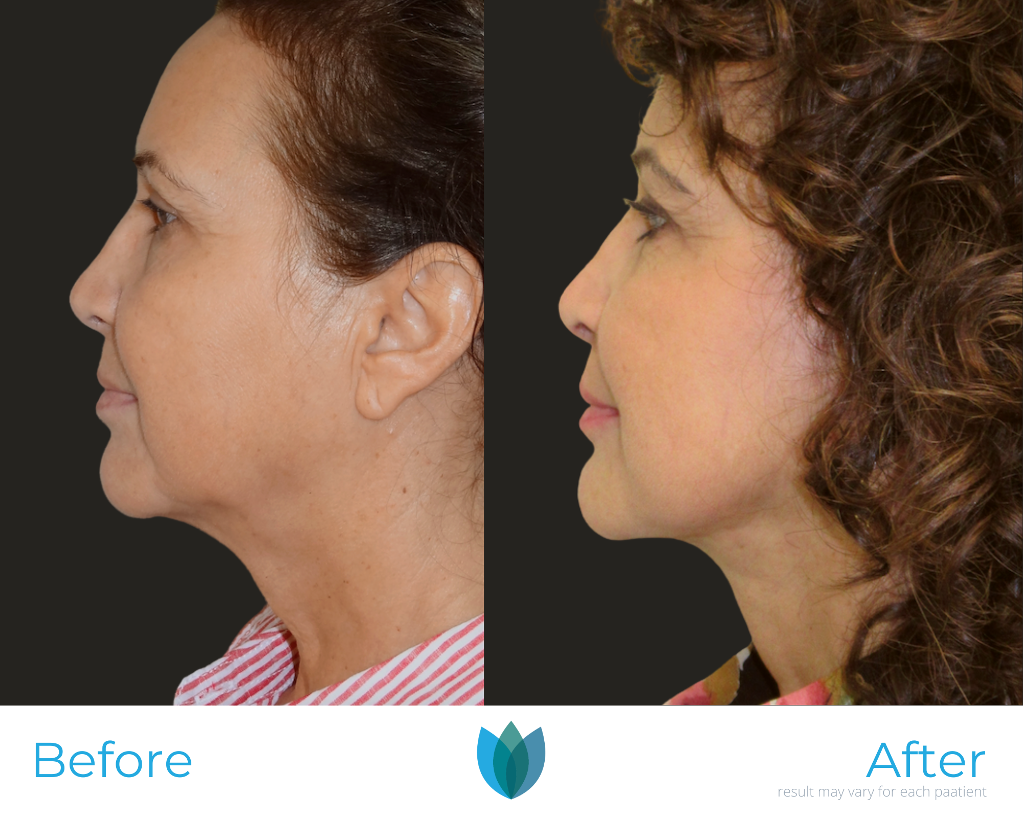 Facelift Before and After Pictures Tampa and The Villages, FL