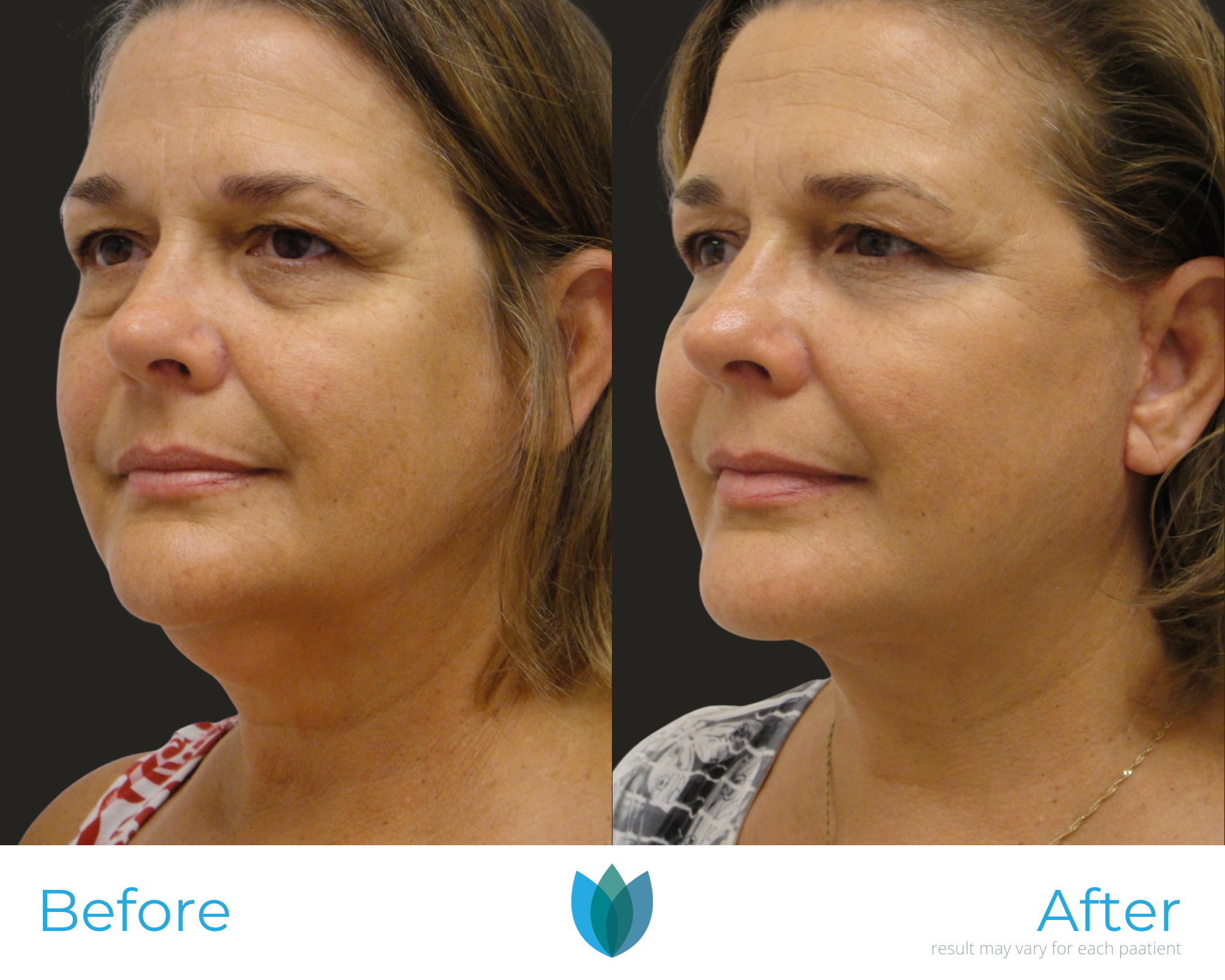 Facelift Before and After Pictures Tampa and The Villages, FL