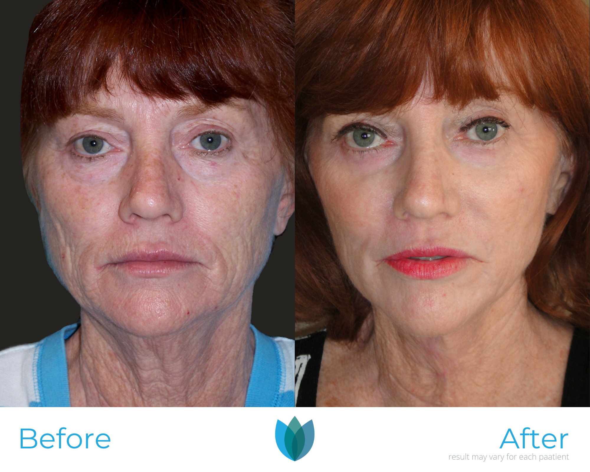 Facelift Before and After Pictures Tampa and The Villages, FL