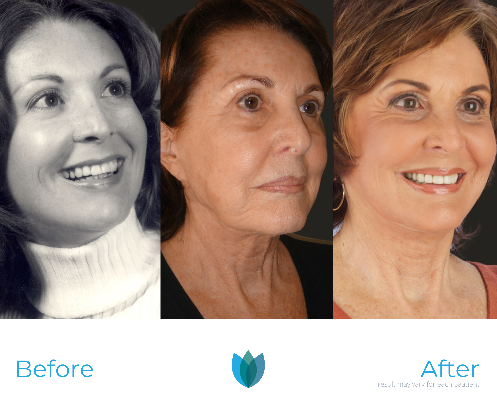Facelift Before and After Pictures Tampa and The Villages, FL