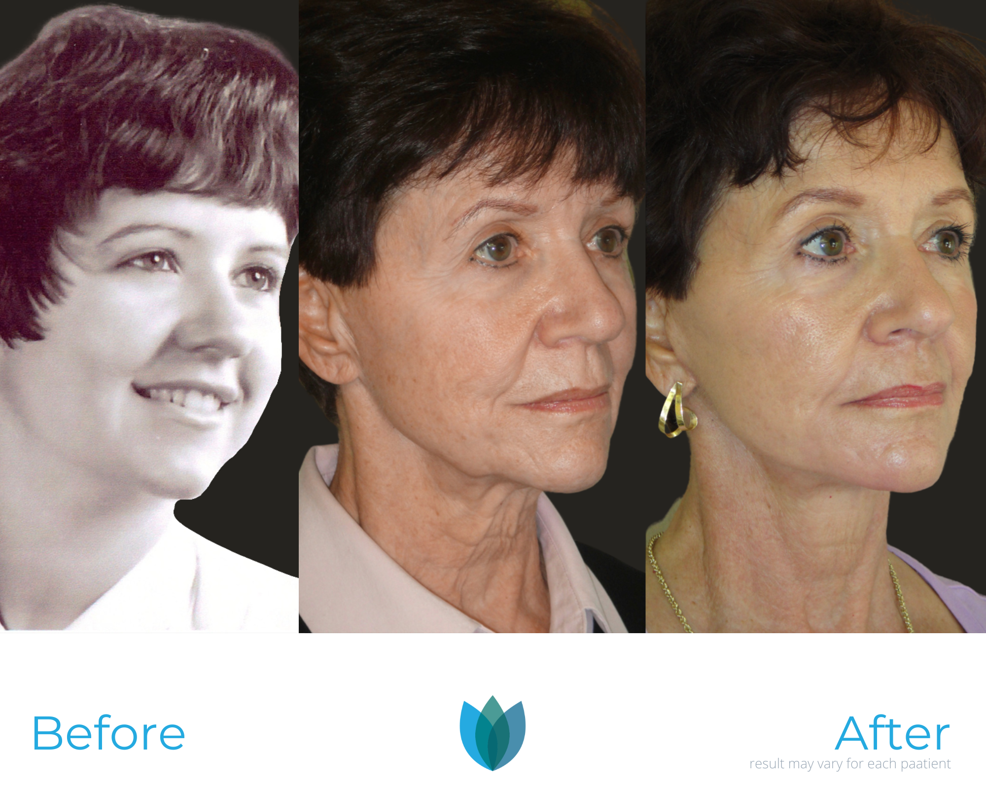 Facelift Before and After Pictures Tampa and The Villages, FL