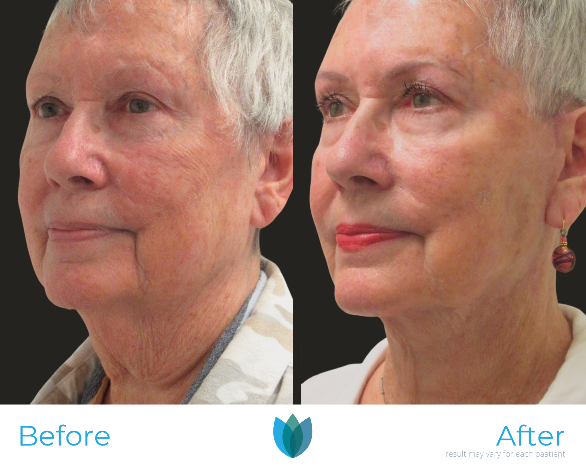 Facelift Before and After Pictures Tampa and The Villages, FL