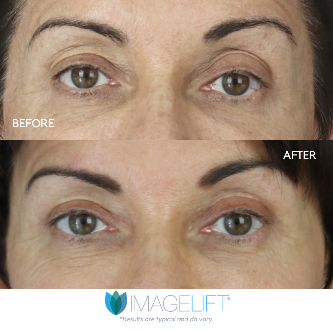 Upper blepharoplasty in Tampa and The Villages, FL