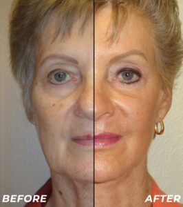 ImageLift™ facelift B&A555